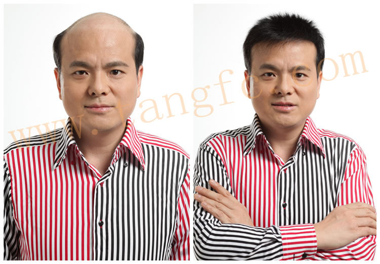 脫發(fā)治療應(yīng)警惕陷入誤區(qū) 脫發(fā)治療應(yīng)警惕陷入誤區(qū)