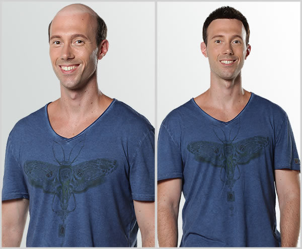 綠茶能治療脫發(fā)嗎？