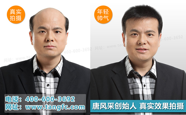 禿頂補(bǔ)發(fā)就選唐風(fēng)采補(bǔ)發(fā)機(jī)構(gòu) 禿頂補(bǔ)發(fā)就選唐風(fēng)采補(bǔ)發(fā)機(jī)構(gòu)