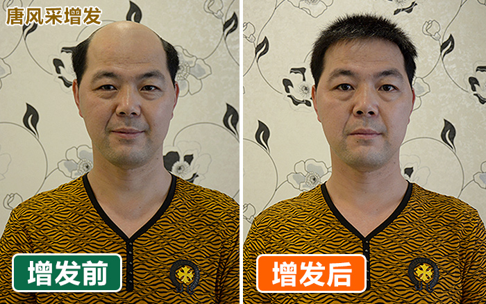 織發(fā)可以解決禿發(fā)癥狀嗎？真人假發(fā)織發(fā)補(bǔ)發(fā)效果請看這！