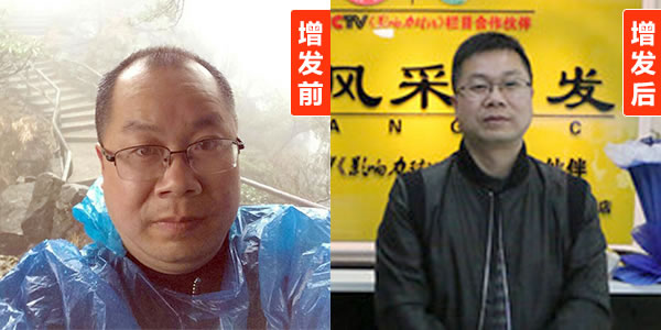 頭發(fā)再生的方法有哪些？看了你就知道了！