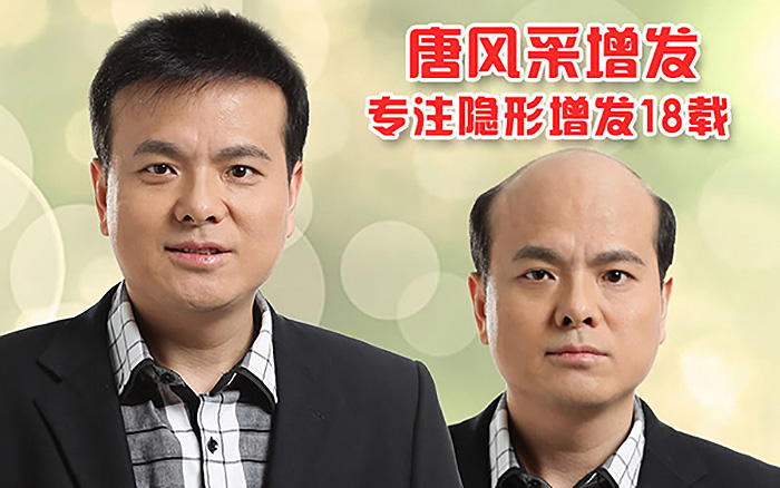 脂溢性脫發(fā)能治好嗎？專(zhuān)業(yè)機(jī)構(gòu)為你解答發(fā)體癥狀