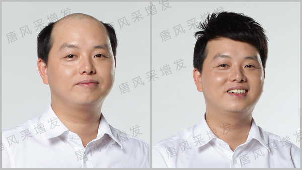 唐風采補發(fā)，解決頭發(fā)稀疏最快最好的技術