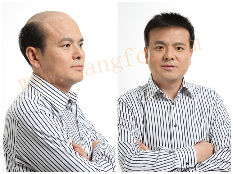 發(fā)際線后移移植多少錢？選擇這一家的理由是什么？