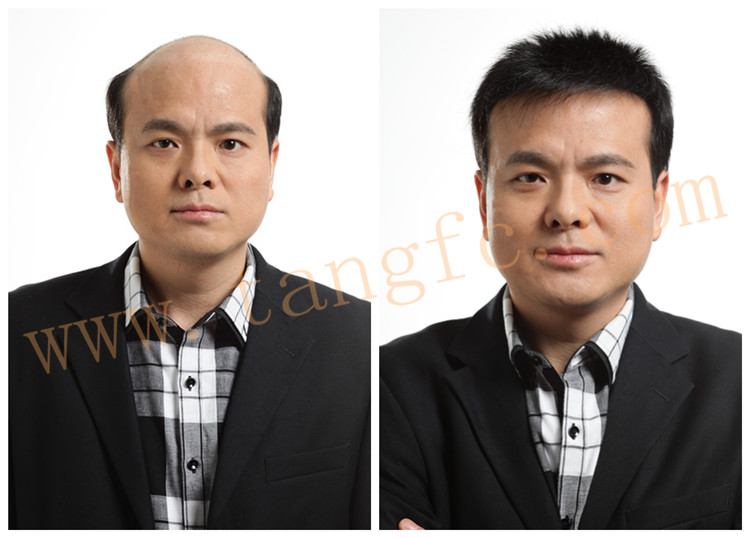 廈門頭發(fā)稀少如何解決？人為什么會脫發(fā)