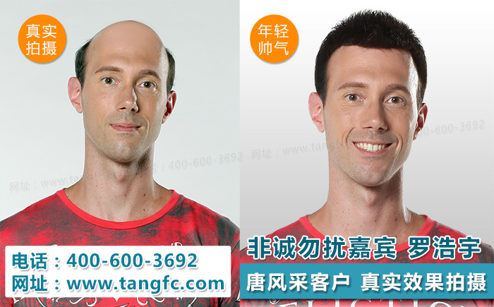 發(fā)際線高的同學，在同齡人中立馬看出年齡差距&nbsp;