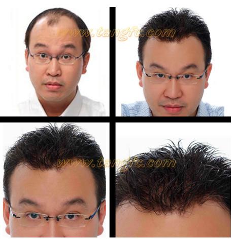 來自NASA的黑科技生發(fā)頭盔，禿頂有救了？