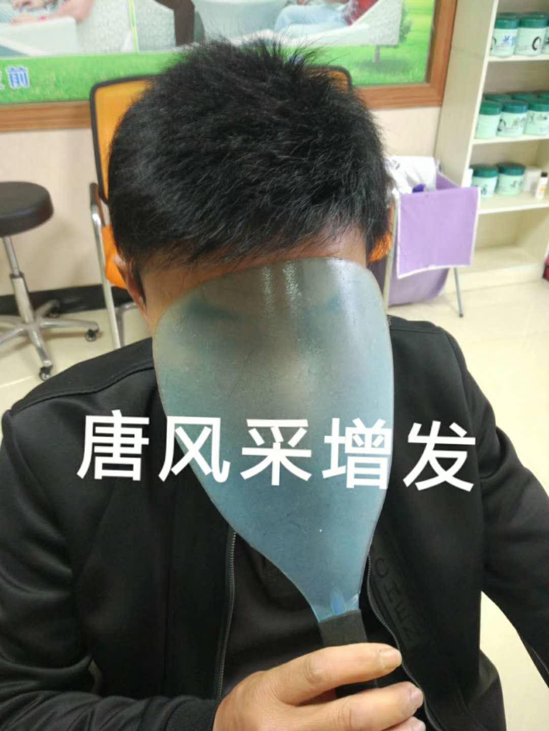 脫發(fā)謝頂壓力大，增發(fā)補(bǔ)發(fā)一身輕！