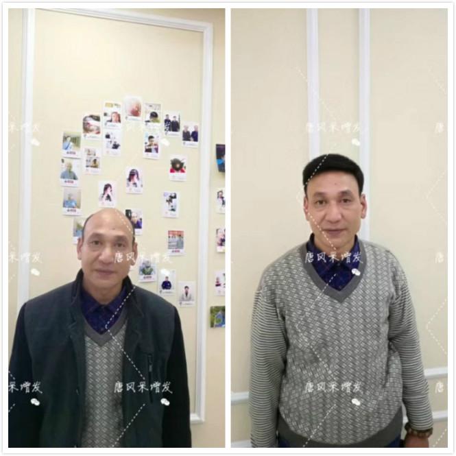 頭發(fā)少怎么辦？