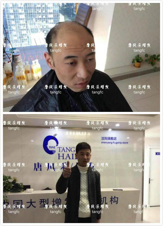 為脫發(fā)者解千愁，增發(fā)前后的驚人對比！