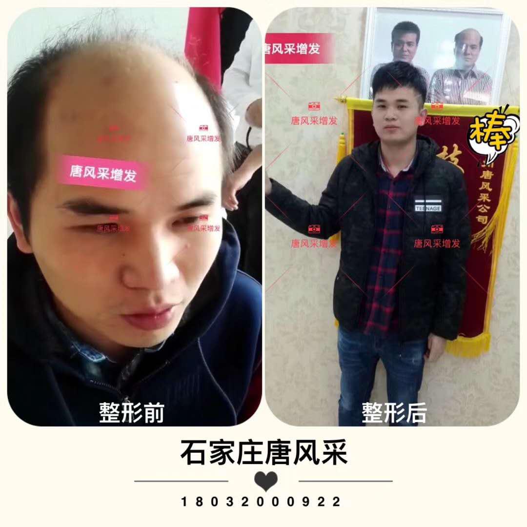 頭發(fā)少怎么辦？