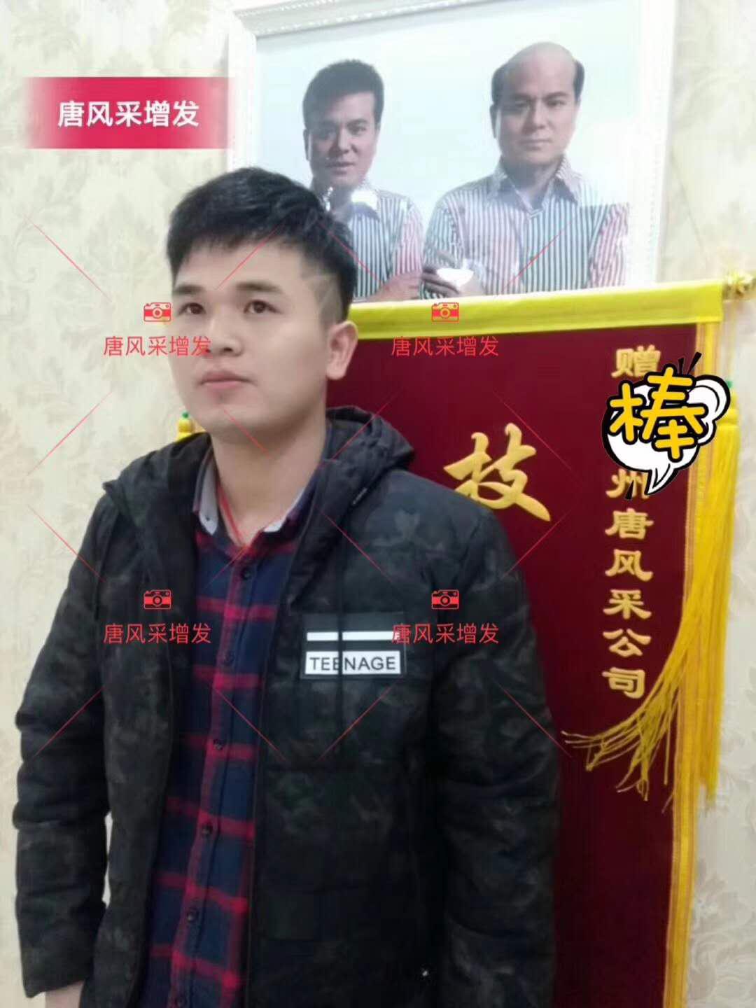 為脫發(fā)者解千愁，增發(fā)前后的驚人對比！