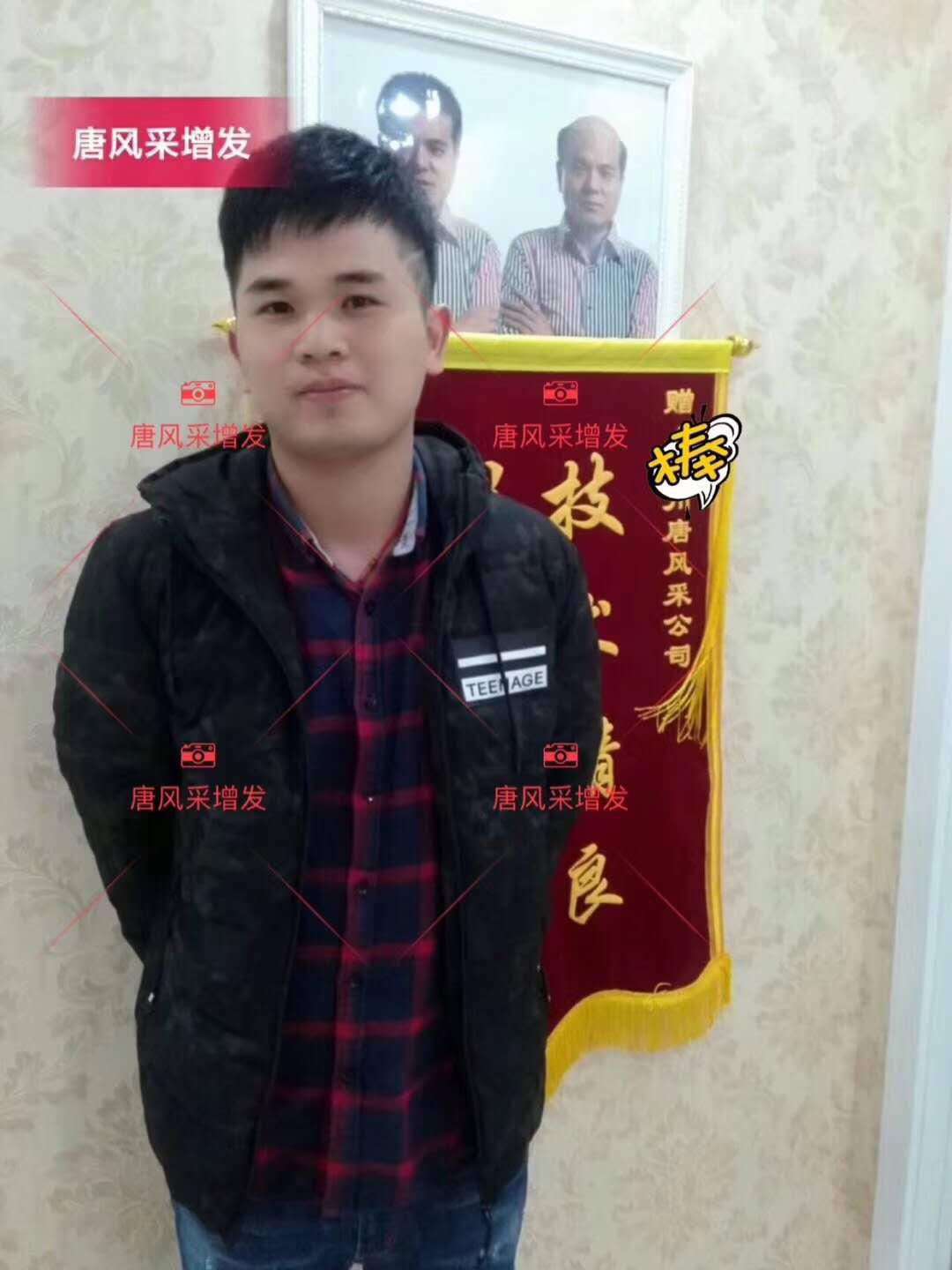 為脫發(fā)者解千愁，增發(fā)前后的驚人對比！