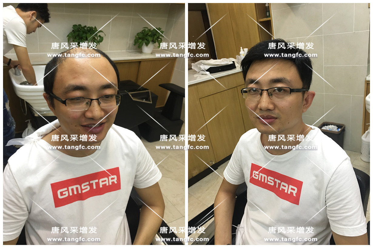 謝頂會(huì)坑一輩子？ 我不禁摸了摸自己頭發(fā)