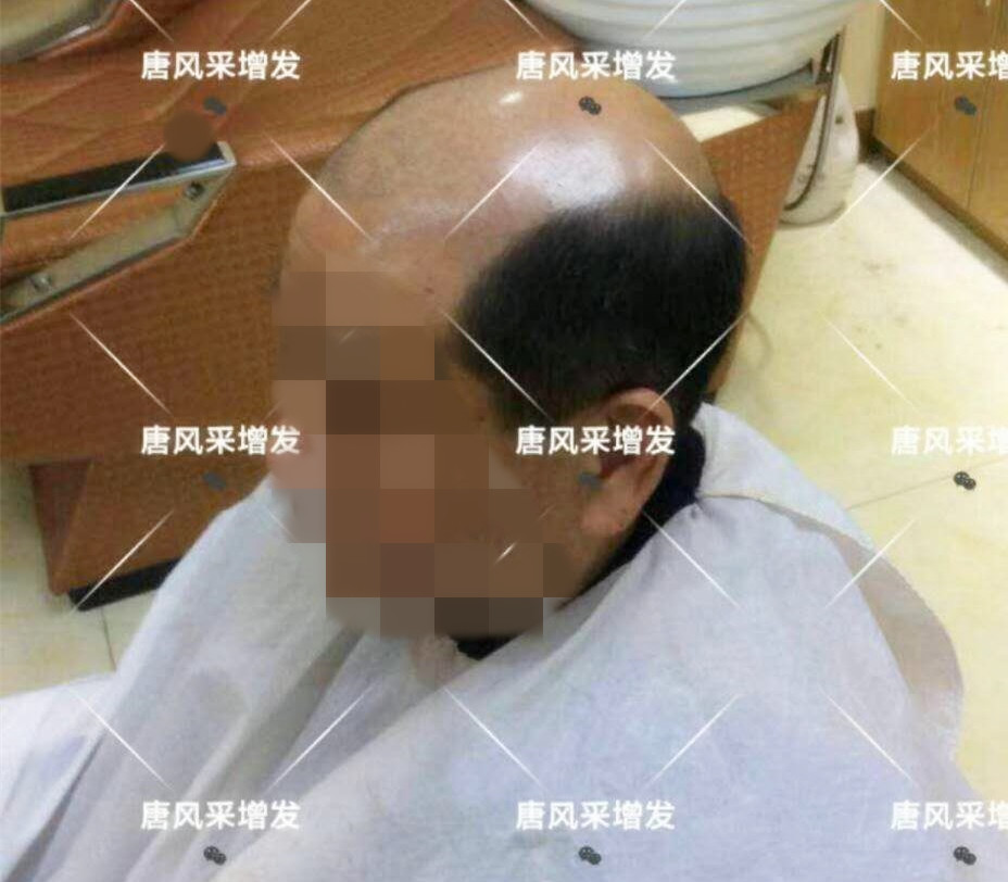 男人脫發(fā)原因多，不能一味怨腎虧！