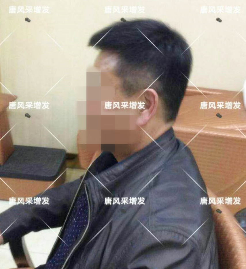 男人脫發(fā)原因多，不能一味怨腎虧！