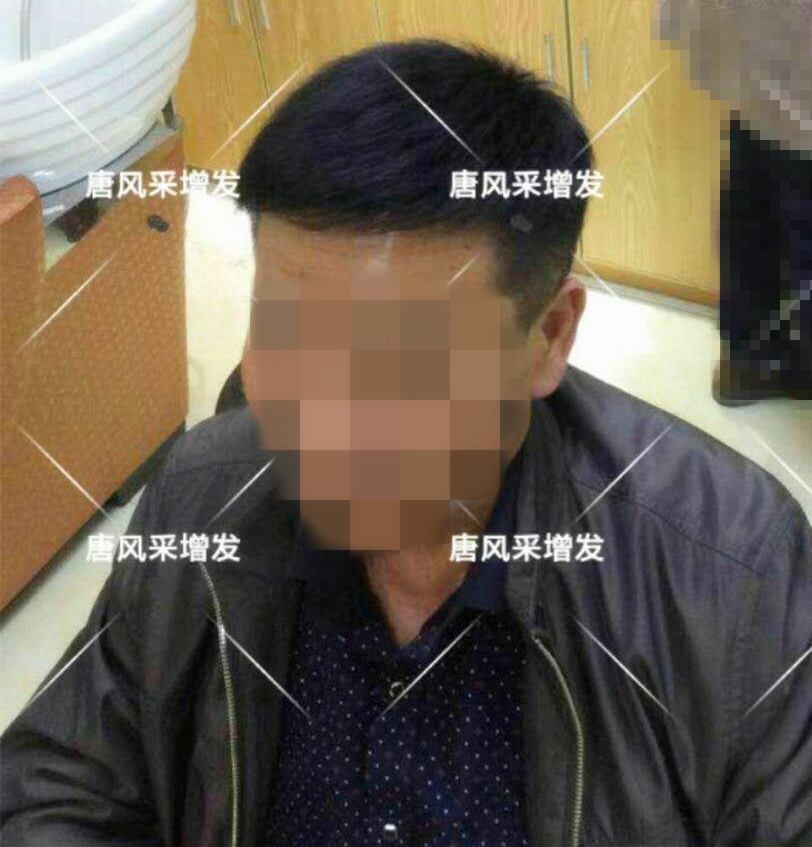 男人脫發(fā)原因多，不能一味怨腎虧！