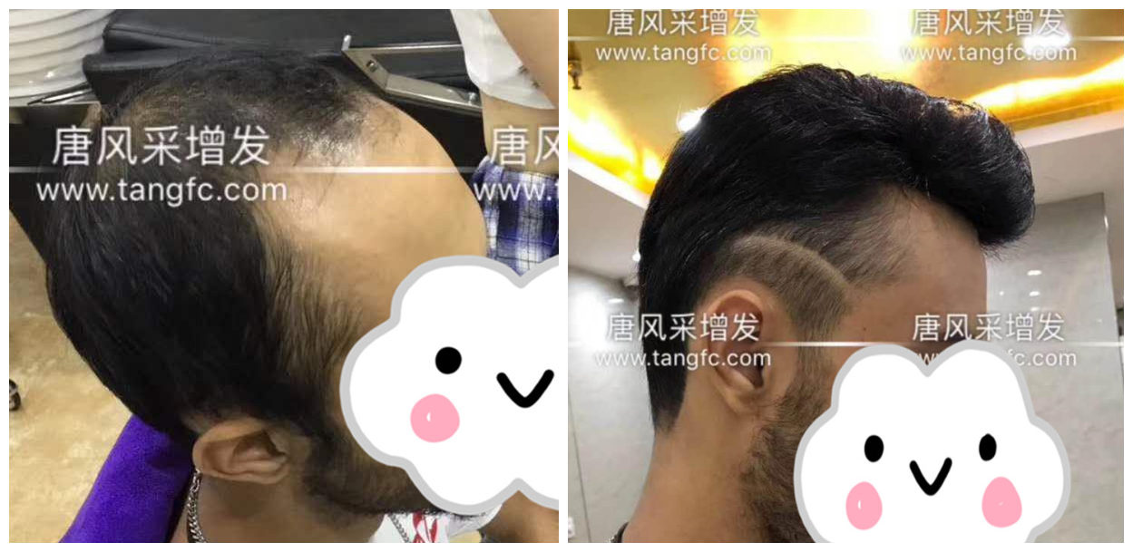 男士假發(fā)容易看出來嗎？看看做過頭發(fā)的發(fā)友怎么說！