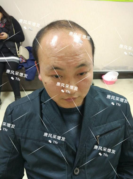 人民公仆也脫發(fā)，廈門夏先生增發(fā)記