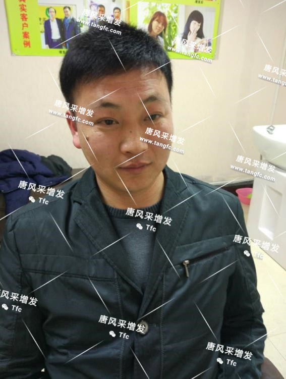 人民公仆也脫發(fā)，廈門夏先生增發(fā)記