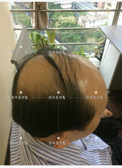 存款重要還是頭發(fā)重要？聽聽李先生怎么說！