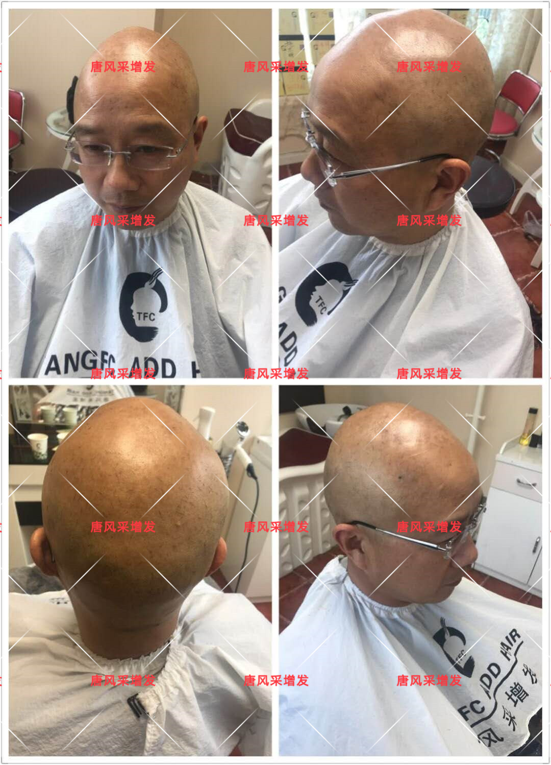 10年脫發(fā)困擾，一次性解決，唐風(fēng)采助力查先生“夢想成真”
