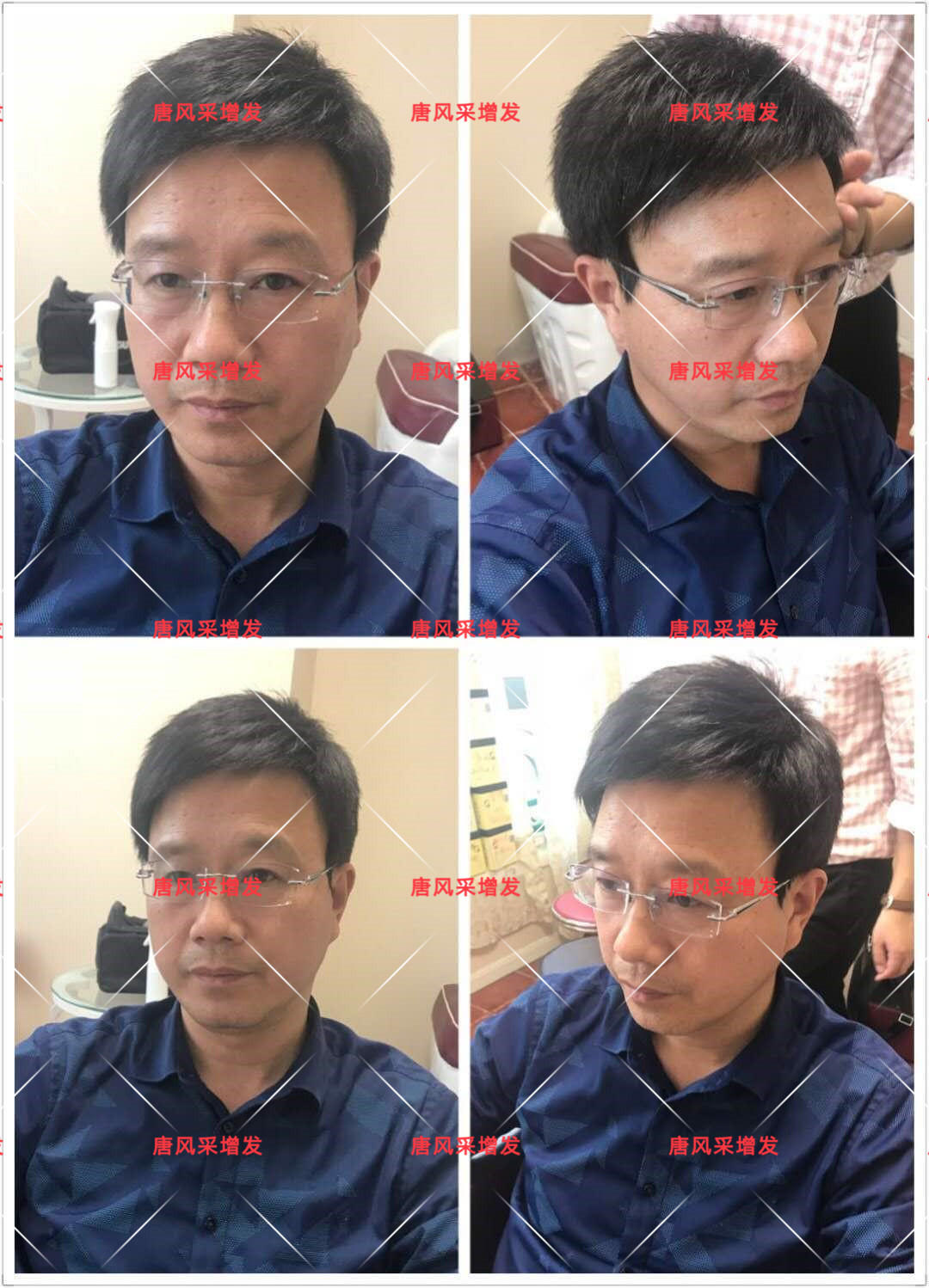 10年脫發(fā)困擾，一次性解決，唐風(fēng)采助力查先生“夢想成真”