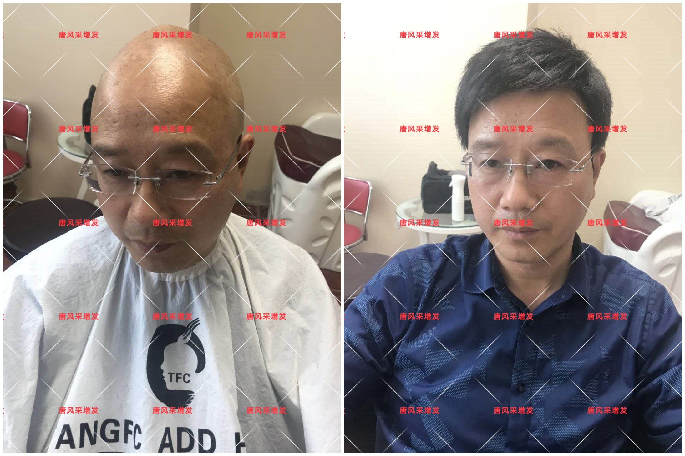 10年脫發(fā)困擾，一次性解決，唐風(fēng)采助力查先生“夢想成真”