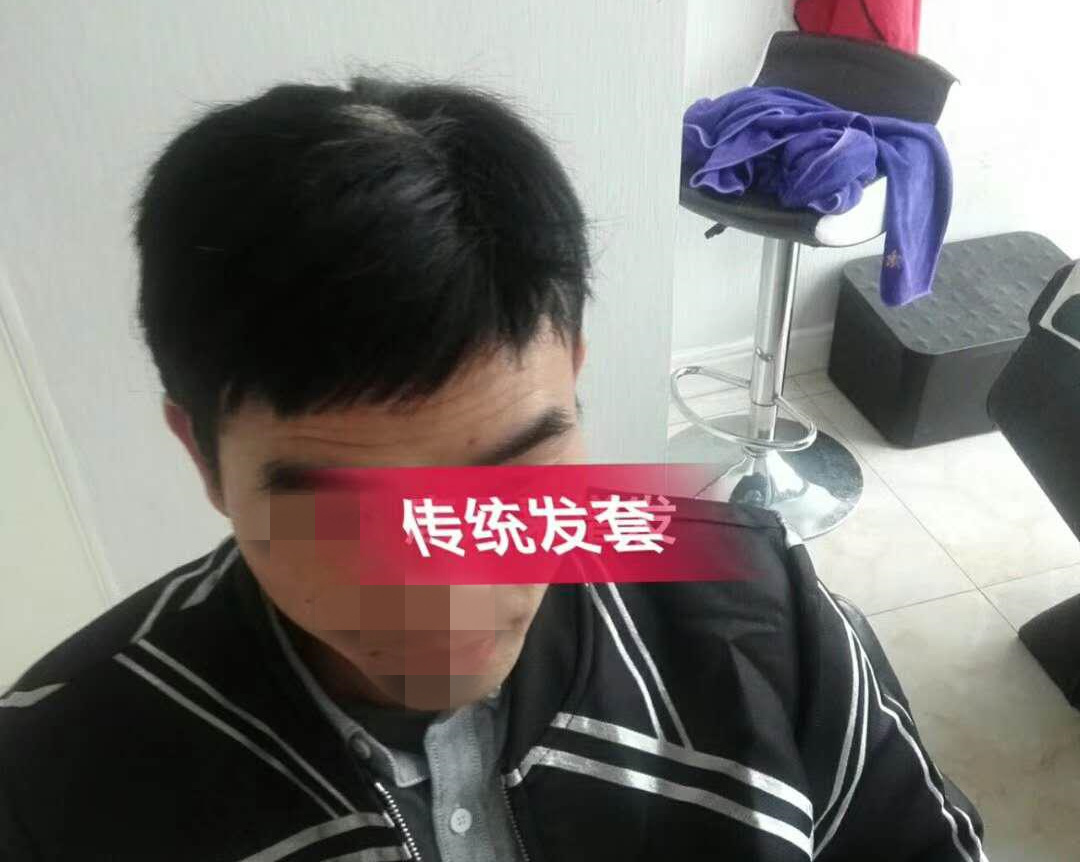 開始脫發(fā)的朋友上醫(yī)院，見到專家后他徹底絕望了！