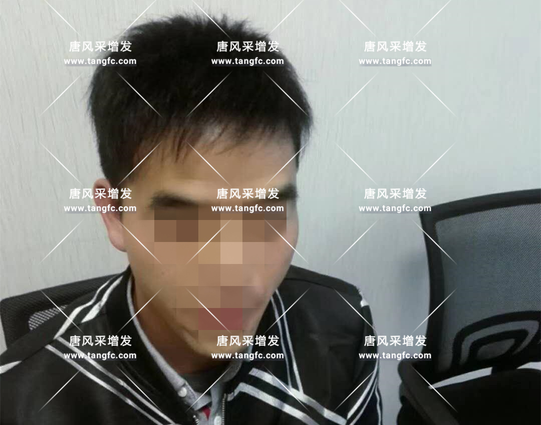 開始脫發(fā)的朋友上醫(yī)院，見到專家后他徹底絕望了！