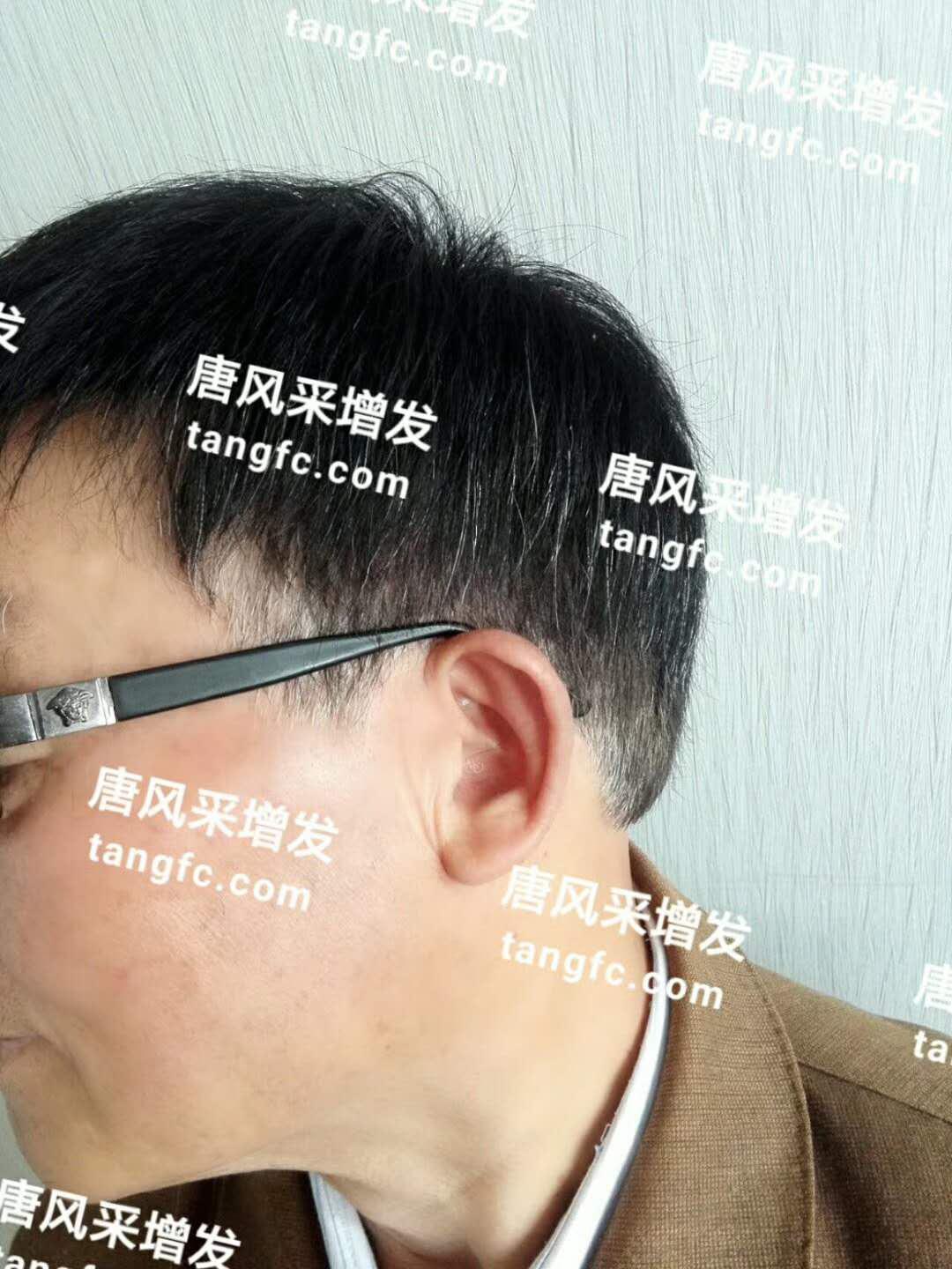 開始脫發(fā)的朋友上醫(yī)院，見到專家后他徹底絕望了！