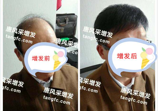 開始脫發(fā)的朋友上醫(yī)院，見到專家后他徹底絕望了！