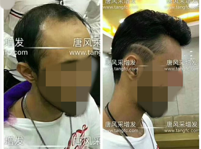 謝頂是顏值也拯救不了的尷尬！