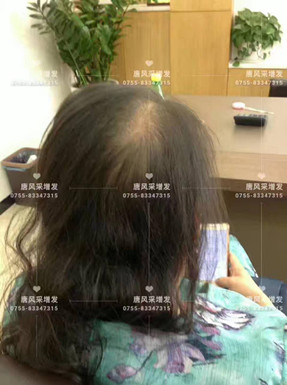 頭發(fā)稀少了，我該拿什么來拯救你？