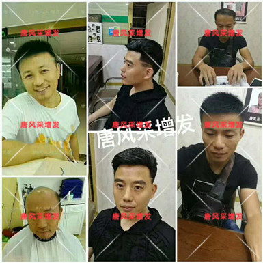 臺州假發(fā)專賣選什么品牌？禿發(fā)謝頂用假發(fā)好嗎？