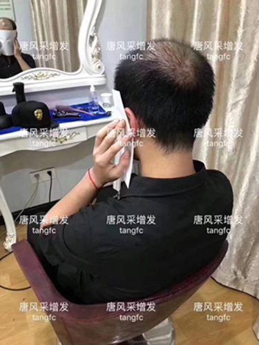 西寧補發(fā)哪里好誰知道？ 90后脫發(fā)了想做補發(fā)！