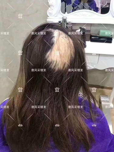 西寧織發(fā)補(bǔ)發(fā)需要多少錢(qián),哪家補(bǔ)發(fā)技術(shù)好？