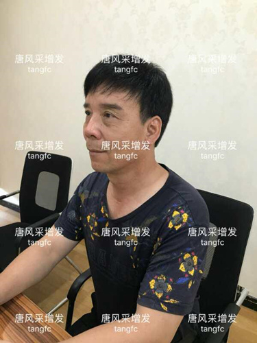 朋友碰面不敢認(rèn)，直擊發(fā)友增發(fā)后的真實(shí)改變！