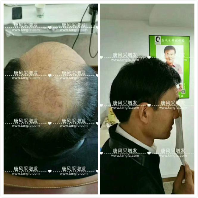 臺州哪里買假發(fā)好，頭發(fā)稀疏適合什么樣的假發(fā)？