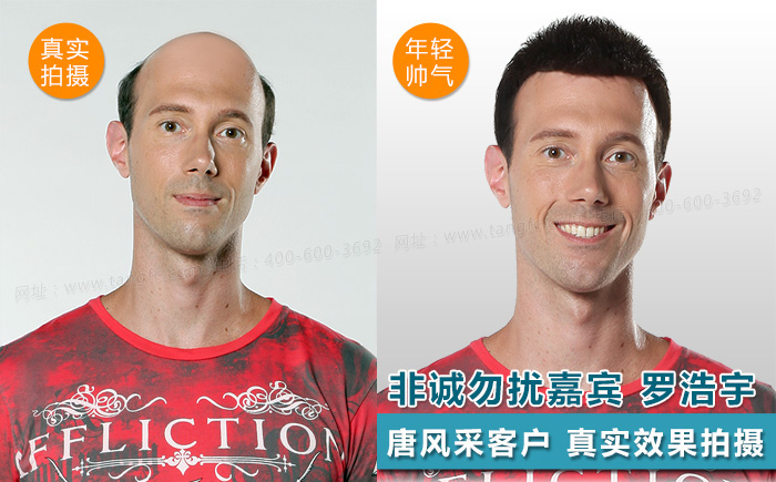 臺州哪里買假發(fā)好，頭發(fā)稀疏適合什么樣的假發(fā)？