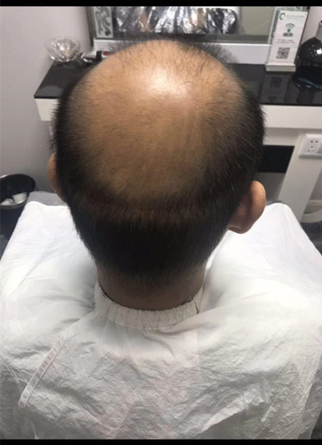 西寧織發(fā)補(bǔ)發(fā)哪家好，真的能改變我的脫發(fā)形象嗎？ 