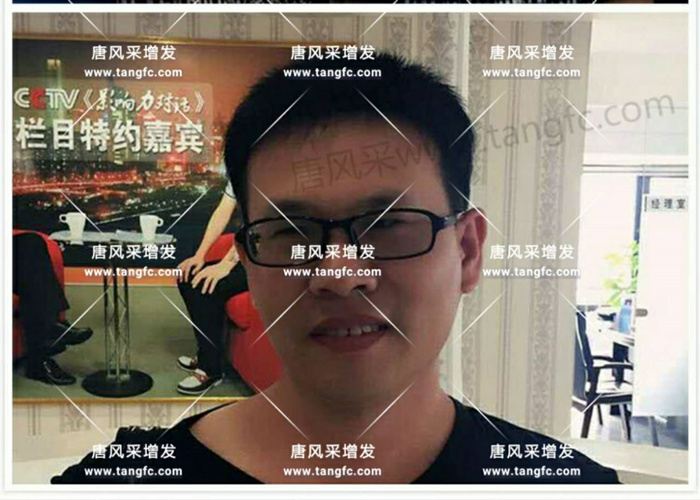 老師，我要你“脫”掉禿頂！