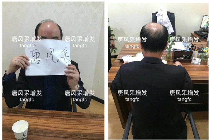 唐風采假發(fā)案例 ，脫發(fā)謝頂后