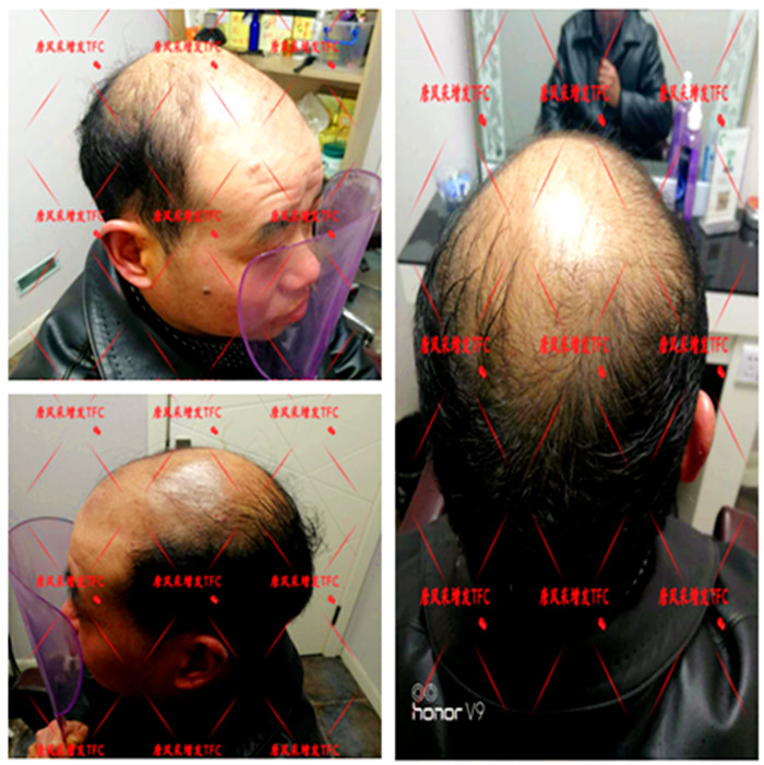 一開始老婆不支持他增發(fā) 陳先生脫發(fā)