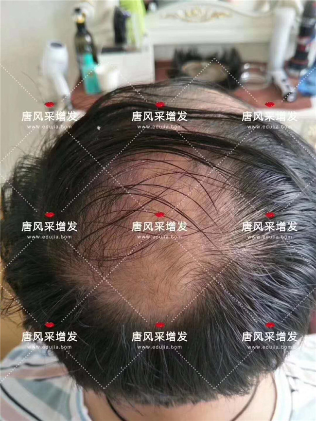 父親節(jié) 年輕的王先生脫發(fā)