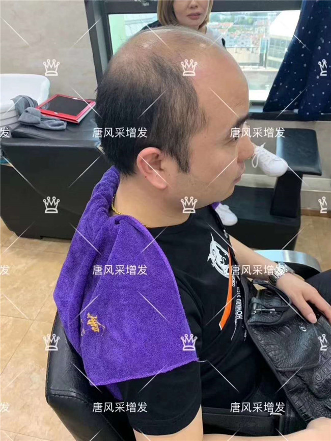 謝頂男人 發(fā)量稀少