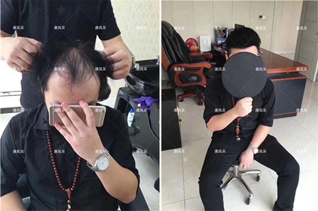 頭頂假發(fā)片 唐風(fēng)采真實(shí)案例