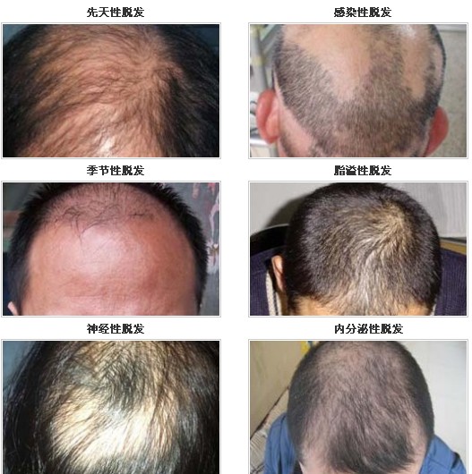 生發(fā)增發(fā) 各種脫發(fā)原因