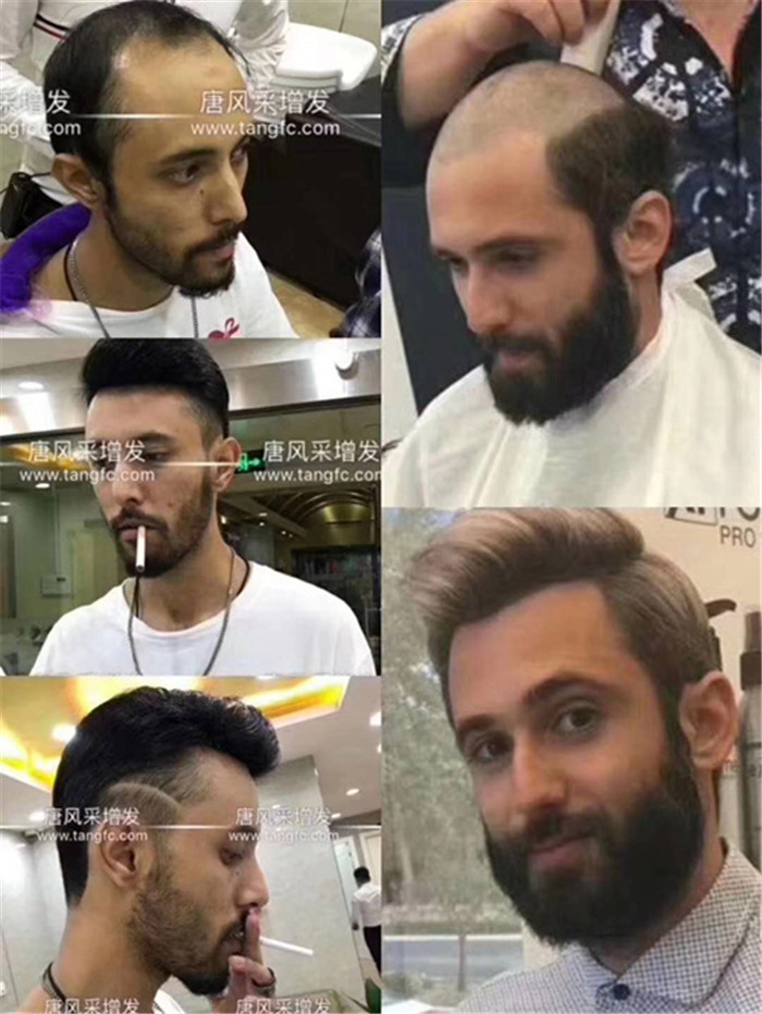 仿真頭皮假發(fā) 唐風(fēng)采客戶案例