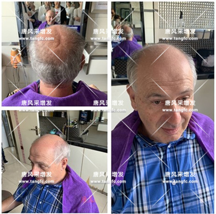 仿真頭皮假發(fā) 唐風(fēng)采客戶案例